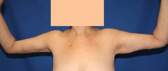 Arm Lift after Weight Loss after 3140996