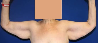 Arm Lift after Weight Loss before 3140996