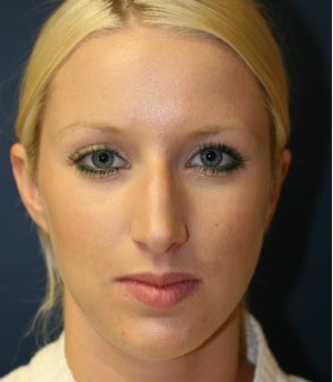 Remove Bump on Top of Nose (Nose Surgery) 1151939