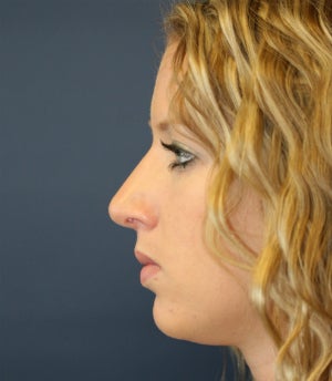 Remove Bump on Top of Nose (Nose Surgery) after 1151939