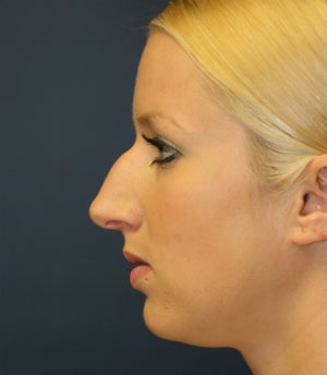 Remove Bump on Top of Nose (Nose Surgery) before 1151939