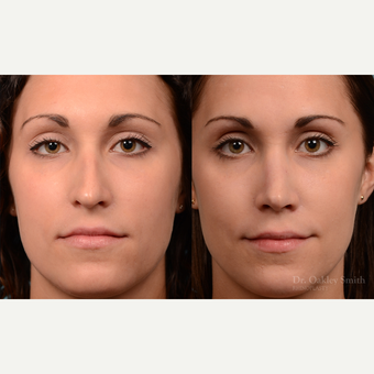25-34 year old woman treated with Rhinoplasty before 3821227
