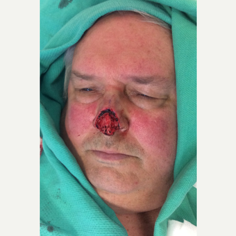 65-74 year old man treated with Nose Surgery before 3741548