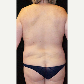 Body Contouring after Lap Band surgery before 3332835