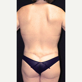 Body Contouring after Lap Band surgery after 3332835