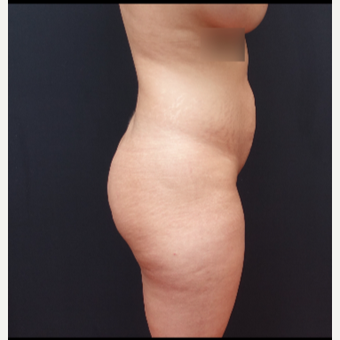 25-34 year old woman treated with Brazilian Butt Lift before 3266992