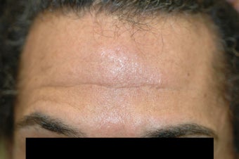 Dysport (Botox) for Deep Forehead Wrinkles in Male Patient before 1118222