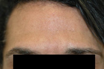 Dysport (Botox) for Deep Forehead Wrinkles in Male Patient after 1118222