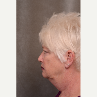55-64 year old woman treated with Facelift before 3530275
