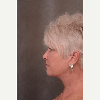 55-64 year old woman treated with Facelift after 3530275
