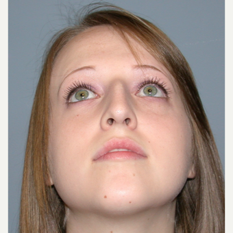 18-24 year old woman treated with Rhinoplasty before 3710491