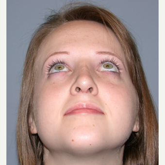 18-24 year old woman treated with Rhinoplasty after 3710491
