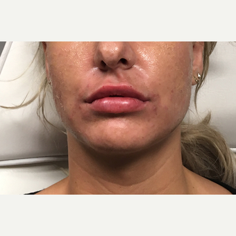35-44 year old woman treated with Juvederm Ultra after 3802195