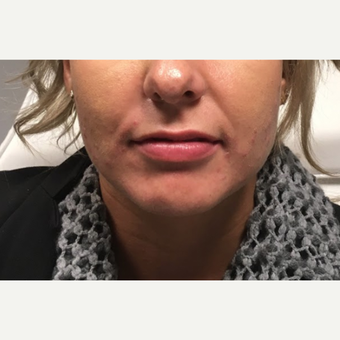 35-44 year old woman treated with Juvederm Ultra before 3802195