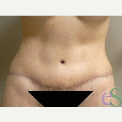 40 year old woman treated with Tummy Tuck after 3484912