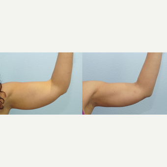 45 yr old Female - Arm Lift after 3099755