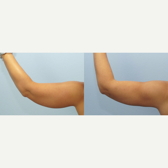 45 yr old Female - Arm Lift before 3099755