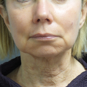 65-74 year old woman treated with Facelift before 3488649