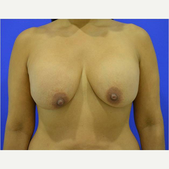 45-54 year old woman treated with Breast Implant Revision before 3744704
