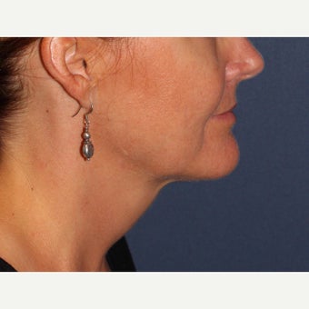 47 year old female treated with ThermiTight under chin after 2132595