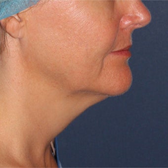 47 year old female treated with ThermiTight under chin before 2132595