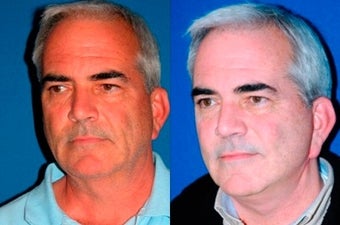 54 year old man treated with Facelift before 3004817