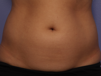 CoolSculpting by Zeltiq to Adbomen before 375536