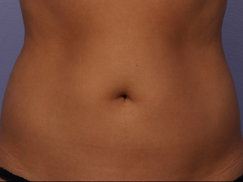 CoolSculpting by Zeltiq to Adbomen after 375536