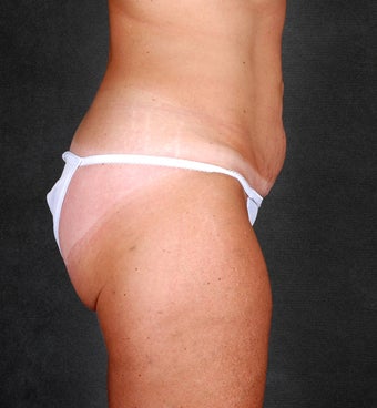 Liposuction of the Hips & Thighs before 1057205