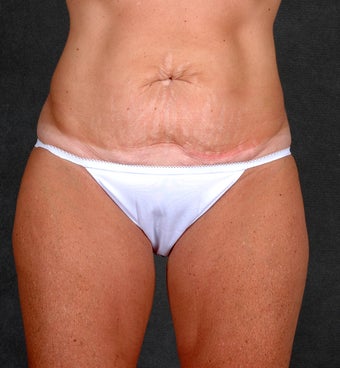 Liposuction of the Hips & Thighs 1057205