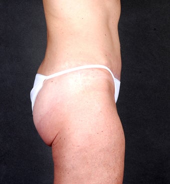 Liposuction of the Hips & Thighs after 1057205