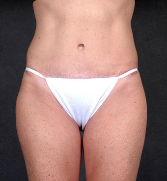 Liposuction of the Hips & Thighs 1057205
