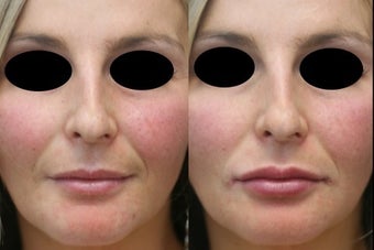 Lip Augmentation With Juvederm before 831419