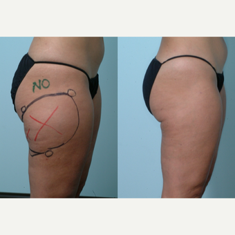 55-64 year old woman treated with Cellulaze after 3642408
