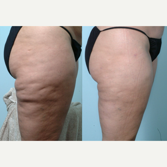 55-64 year old woman treated with Cellulaze before 3642408