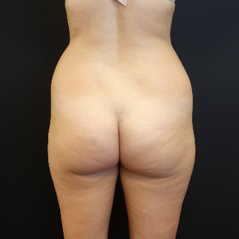 25-34 year old woman treated with Liposuction before 3629932