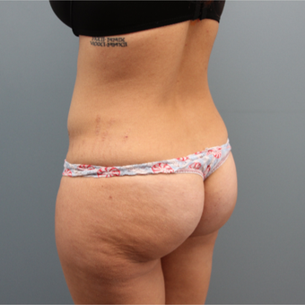 Fat Transfer to the Buttocks was performed on this 33 year old woman before 3467365