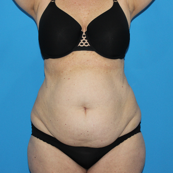55-64 year old woman treated with Tummy Tuck before 3332935