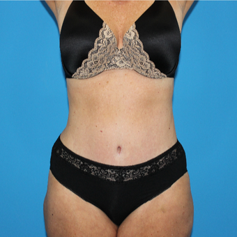 55-64 year old woman treated with Tummy Tuck after 3332935