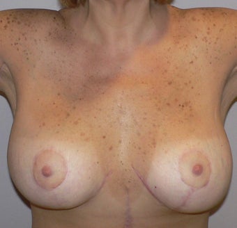 52 year old woman has Breast Lift with Implants after 984156