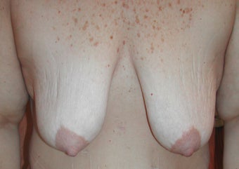 52 year old woman has Breast Lift with Implants before 984156