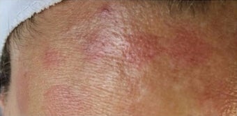 35-44 year old woman treated with Fractional Laser before 2995216