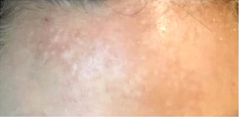 35-44 year old woman treated with Fractional Laser after 2995216