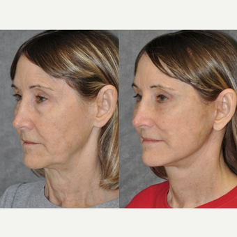 60 year old woman - Mini Facelift - Mini Lift - Deep Plane Mini Lift before 1746133