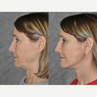 60 year old woman - Mini Facelift - Mini Lift - Deep Plane Mini Lift after 1746133