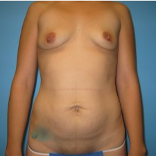 25-34 year old woman treated with Mommy Makeover before 3293473