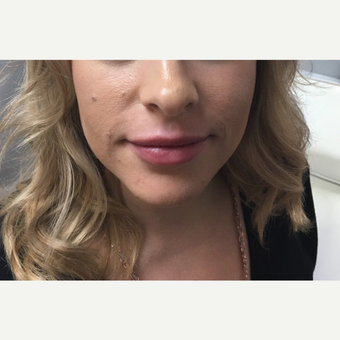 25-34 year old woman treated with Juvederm Ultra after 3781921