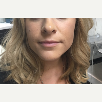 25-34 year old woman treated with Juvederm Ultra before 3781921