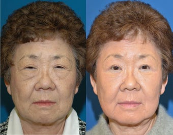 Full face laser resurfacing before 932429