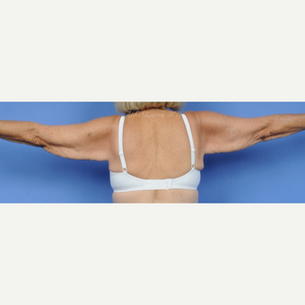 63 year old woman treated with Posterior Arm Lift before 3228521